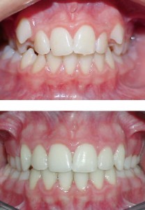 MalOcclusion